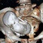 복통으로 병원 찾은 할머니 뱃속에서 ‘석태아’ 발견