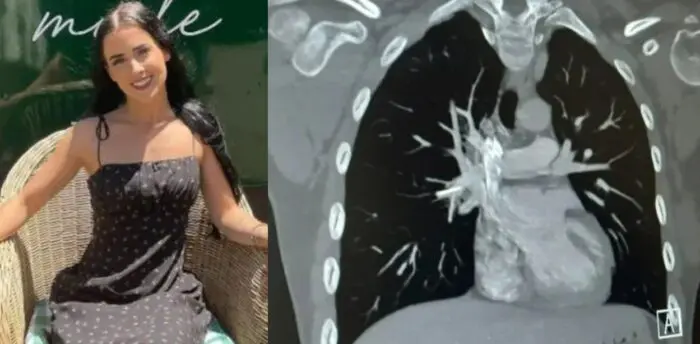 팔에 심은 피임기구 때문에 죽을 뻔한 호주 여성