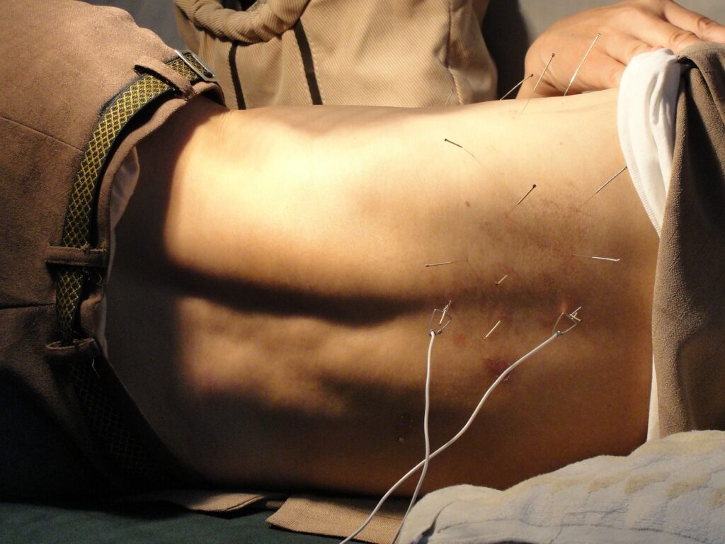 acupuncture-3275458_1280