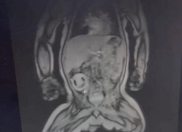 아기 배가 불러 병원 갔더니… 아기 뱃속에서 발견된 ‘기생 태아’