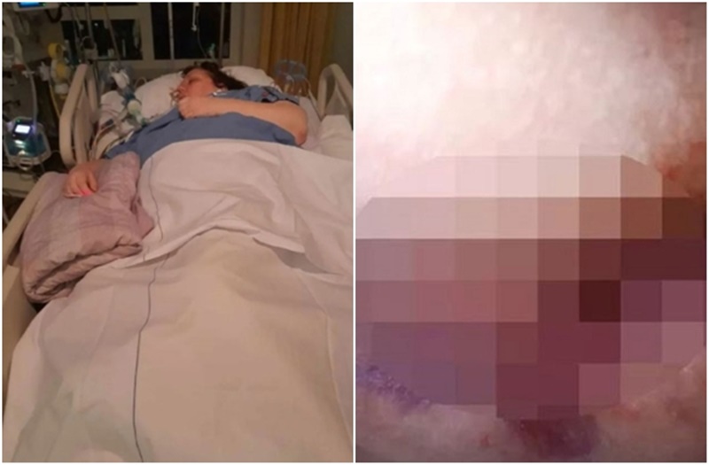 ‘독감이 아니었다’ 엉덩이 20cm 도려낸 여성