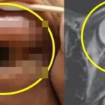 술 취해 엎드려 잤는데… 한쪽 눈 실명 된 남성