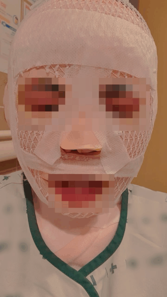 못생겨져야 아내 안떠날것 얼굴에 끓는 물 부은 남편 못생겨져야 아내 안떠날것 얼굴에 끓는 물 부은 남편